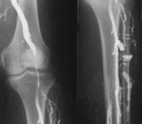 Ekstremitāšu varikozu vēnu diagnostikas iespējas