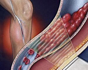 apakšējo ekstremitāšu dziļo vēnu varikozas vēnas